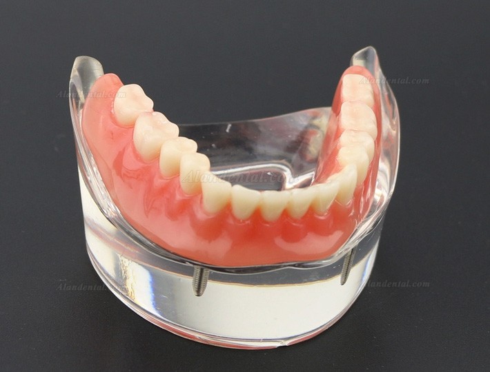 Dental Teeth Model Overdenture Inferior with 2 Implants Study Demo Model 6002 01